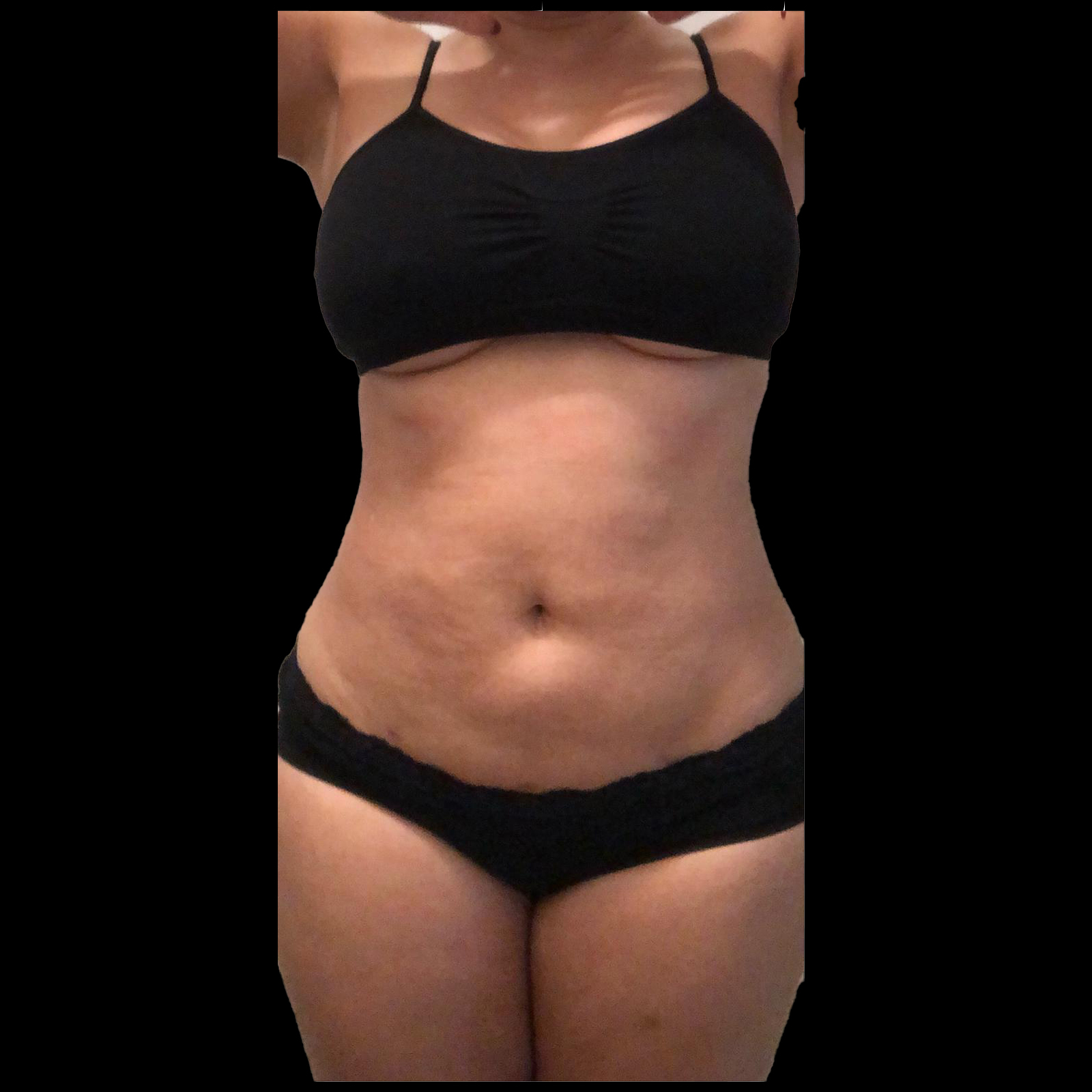 After Lipo 360 - Front View